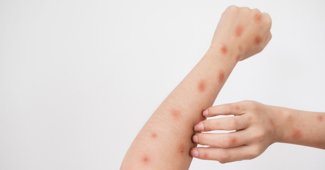 Afbeelding van besmetting met mpox